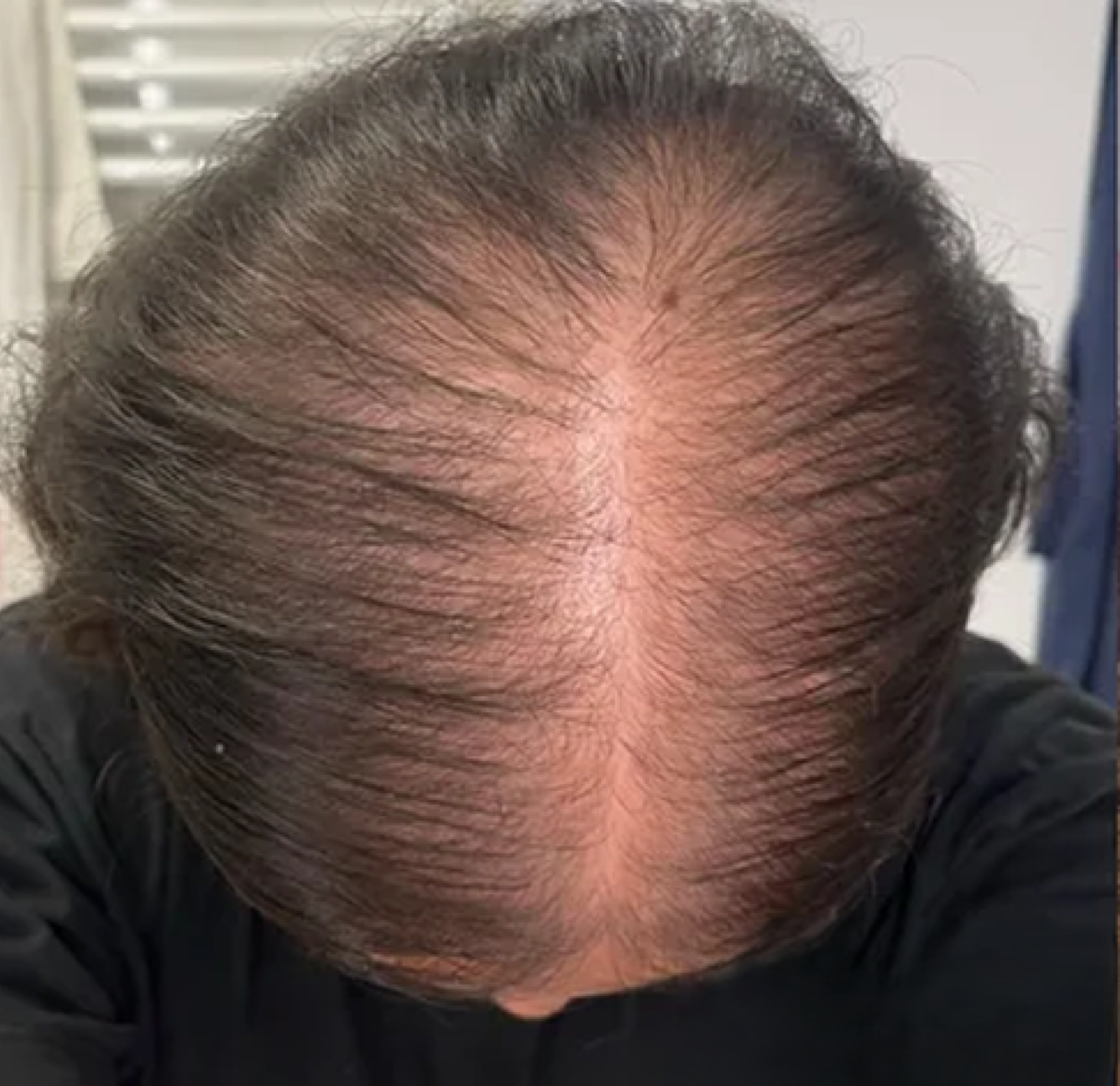 Before - Hair Growth