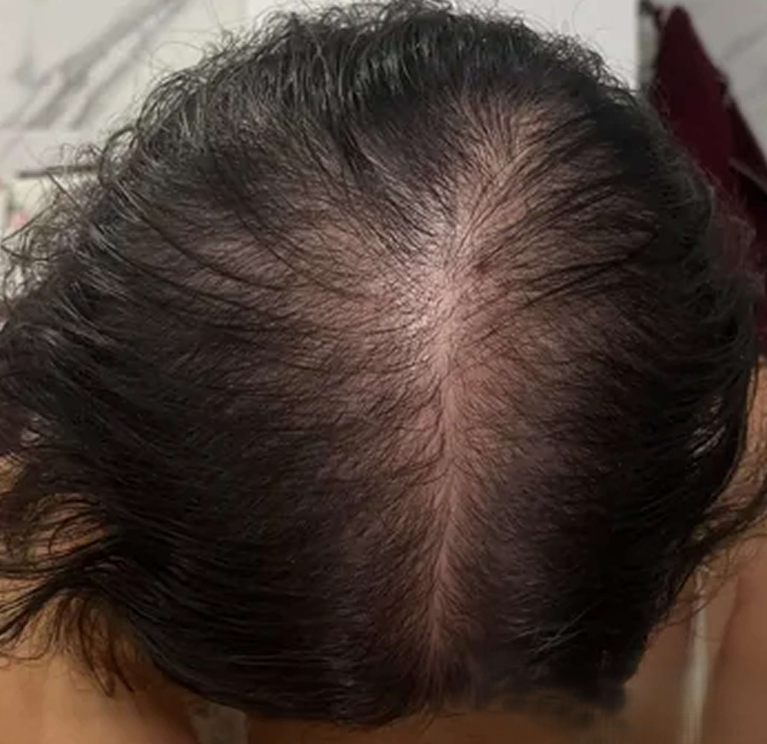 After - Hair Growth