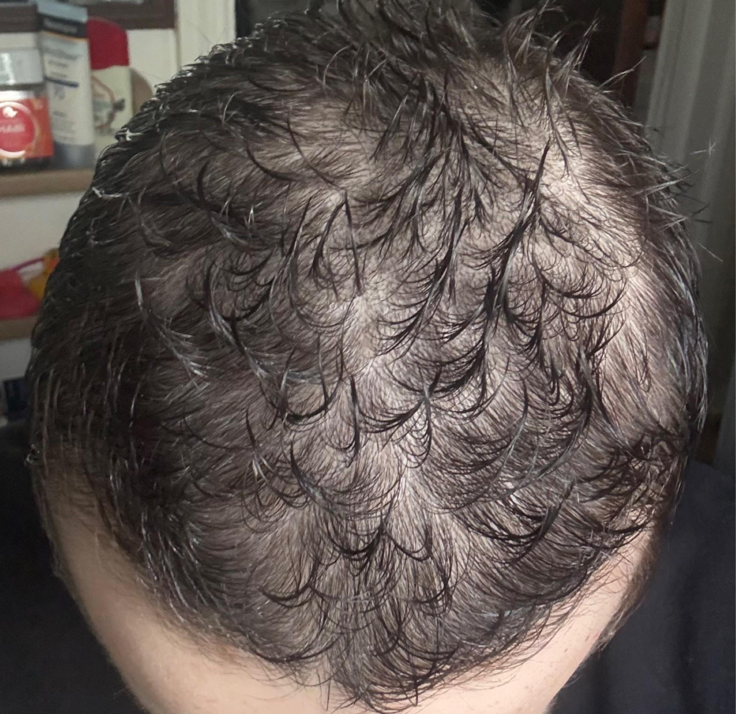 Before - Scalp Health